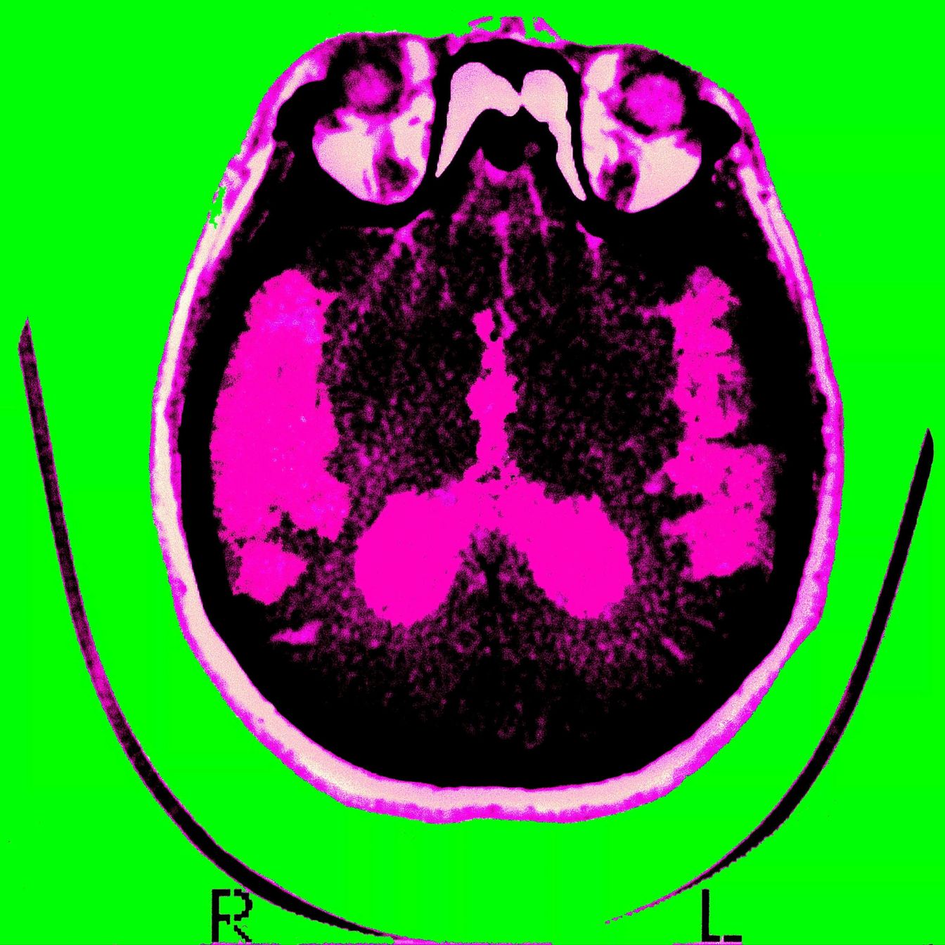 Moving From Single--Target Dogma to Systems--Based Alzheimer's Research